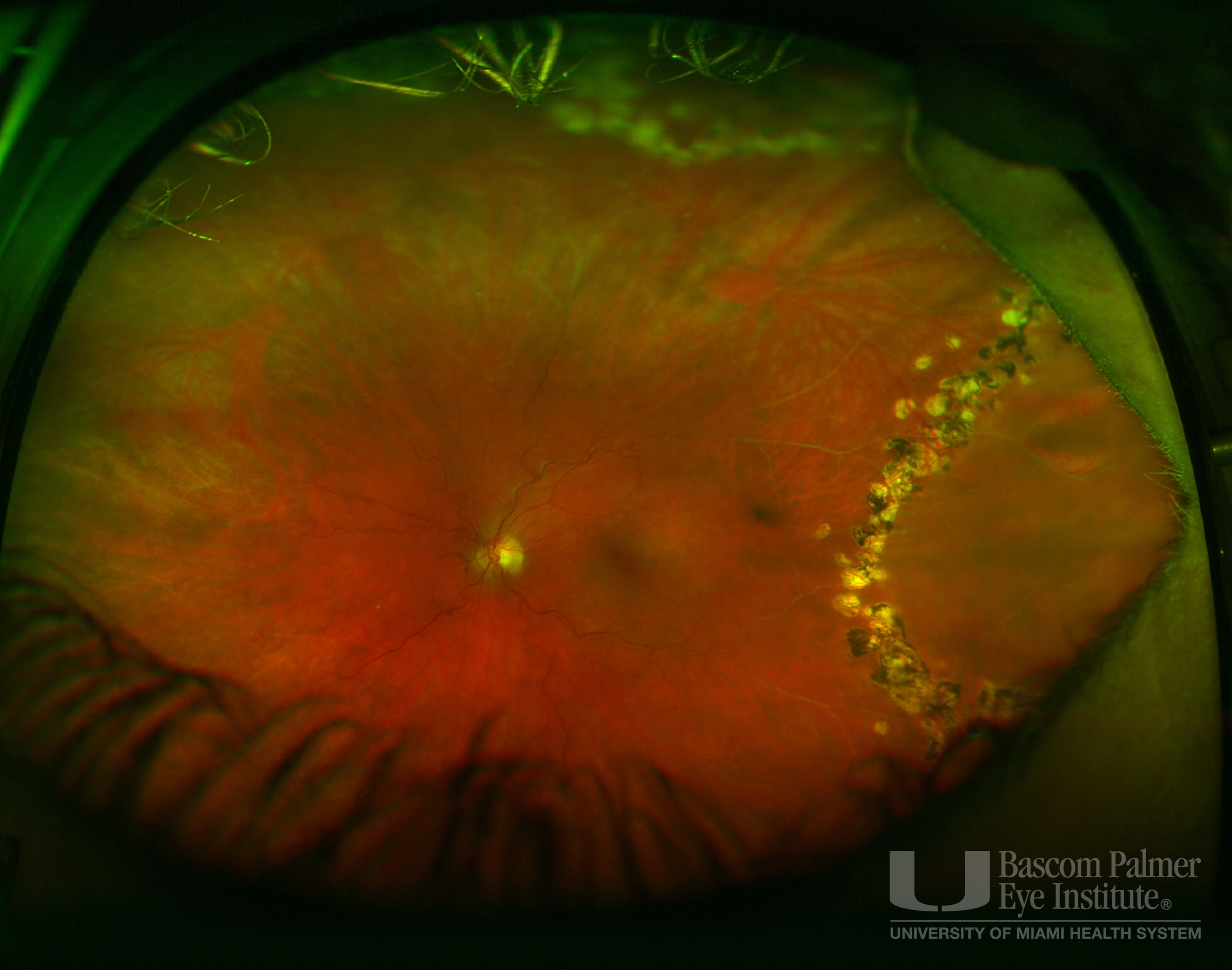 Course Chronic Retinal Detachment with Laser Demarcation